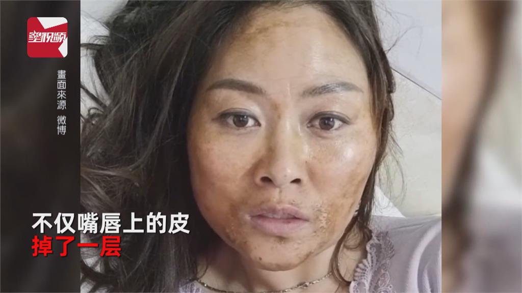 中國確診者臉脫皮、舌發黑　驚爆新變種？醫師解答了！