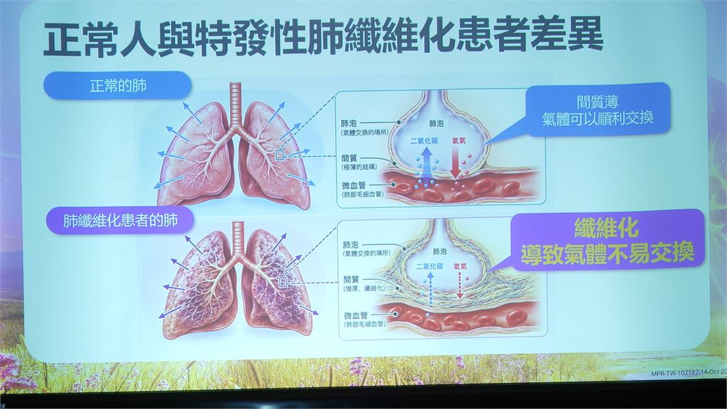 久咳喘不過氣當心「肺纖維化」　新機轉藥物適用兩類肺纖維化適應症
