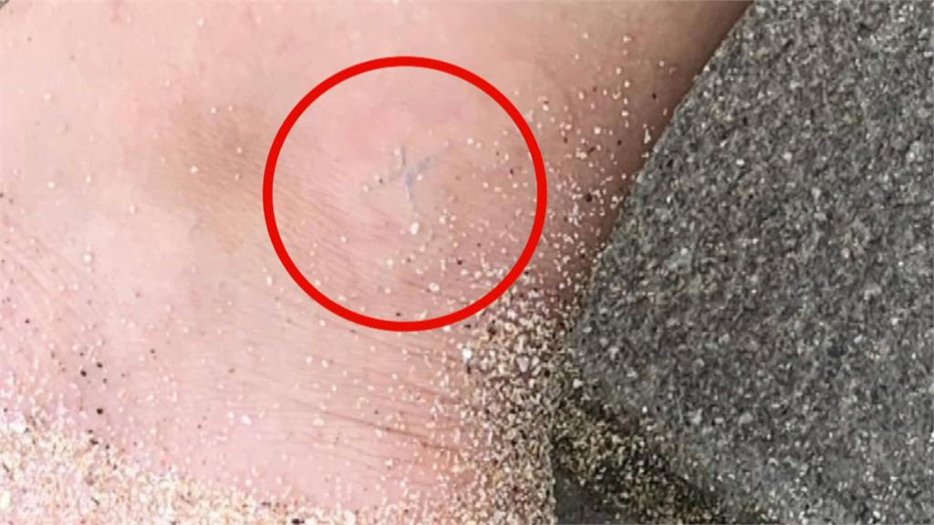 獨家！有毒「錢幣水母」現蹤澎湖　​民眾在沙灘玩驚傳被螫傷