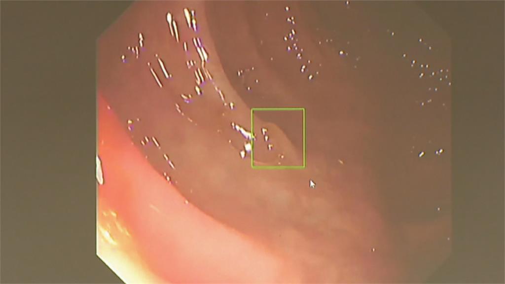 全新「AI　瘜肉偵測系統」　早期發現治療大腸癌