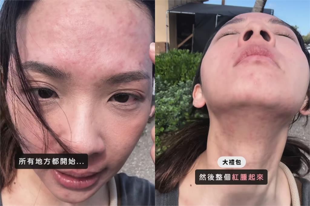 滴妹飛夏威夷做「1件事」大過敏!紅疹爬滿身「近距離爛臉照」嚇壞眾人