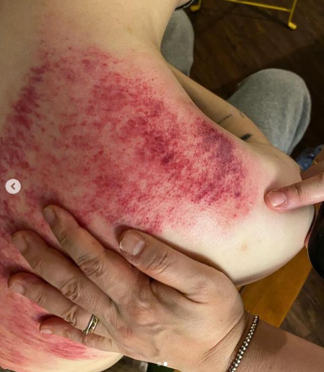 周湯豪攻蛋前驚曬「血紅翅膀」撕背痛炸!認了很氣自己:再這樣會倒下