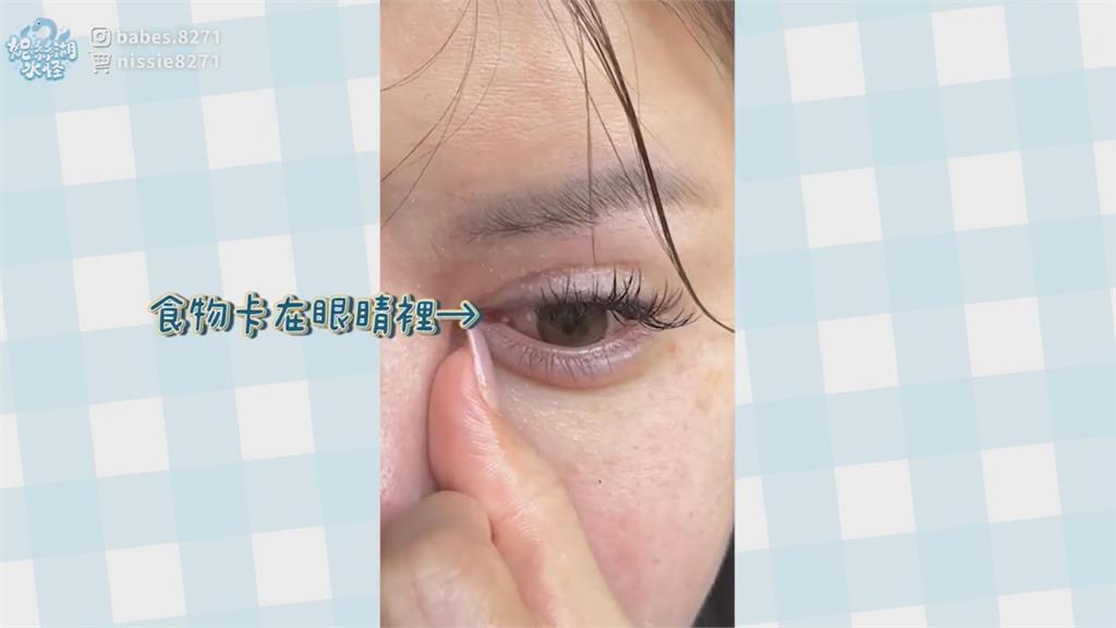 眼睛閉不起來!網美割雙眼皮失敗5次 曝光「吃飯噴眼清不掉」慘況