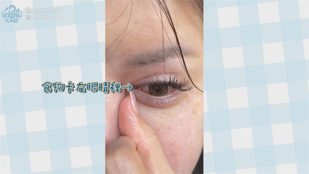 眼睛閉不起來！網美割雙眼皮失敗5次　曝光「吃飯噴眼清不掉」慘況