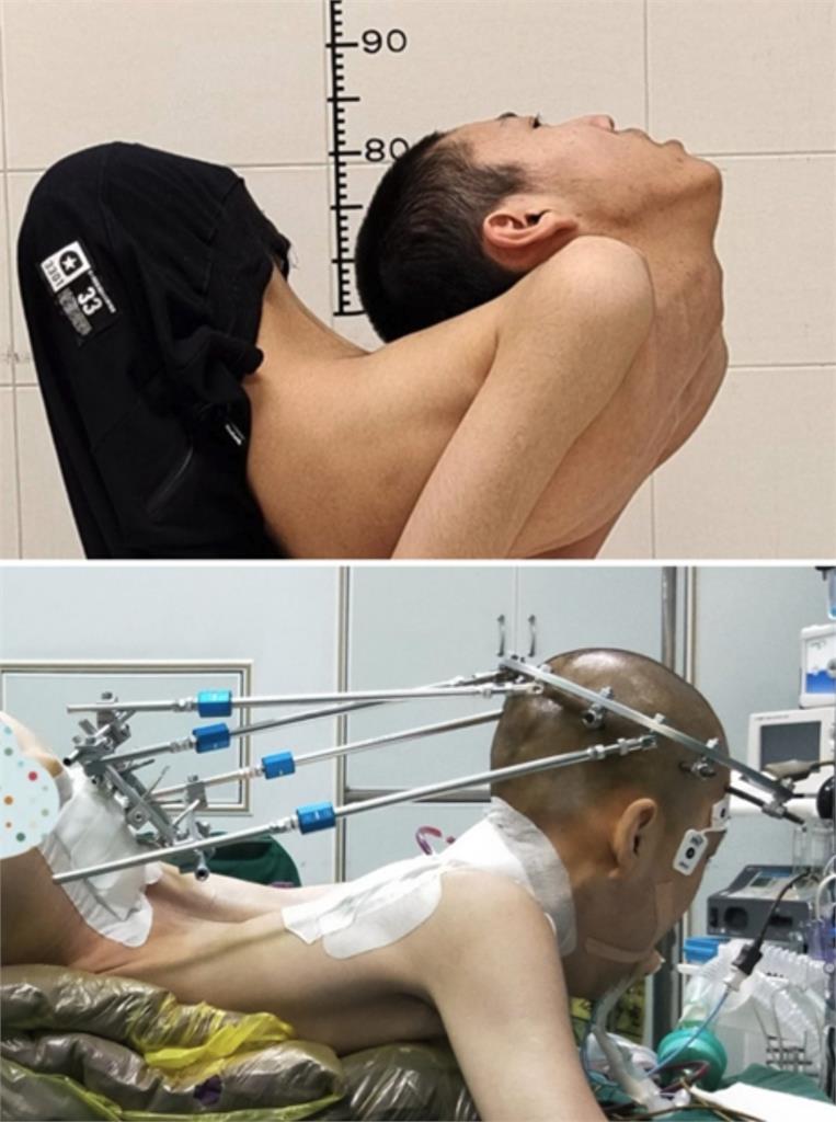 中國「折疊男孩」能躺平了!曾頭貼屁股經「4次斷骨手術」終於打開人生