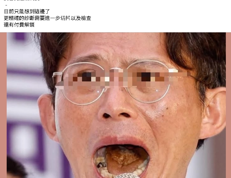 黃國昌「口腔照瘋傳」小草憂心!牙醫史書華拋23點示警:小心癌前病變