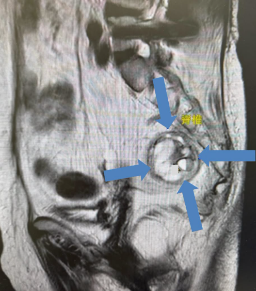 婦肛門劇痛半年只能臥床！驚見直腸後「罕見腫瘤」　醫曝：恐與遺傳肥胖相關