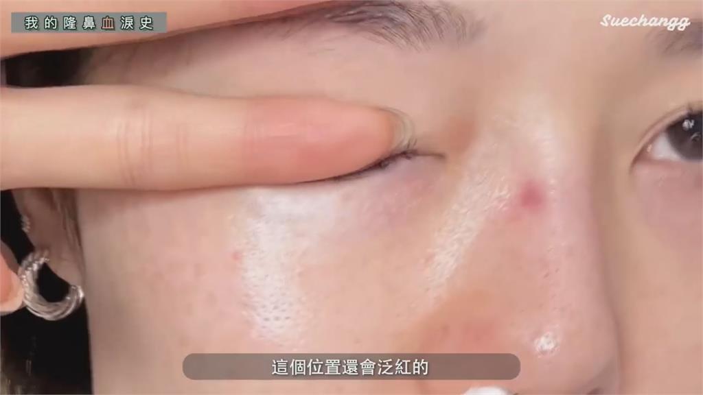 2次隆鼻都失敗!KOL「假體穿出」顯毀容 轉念喊:決定和自己和解