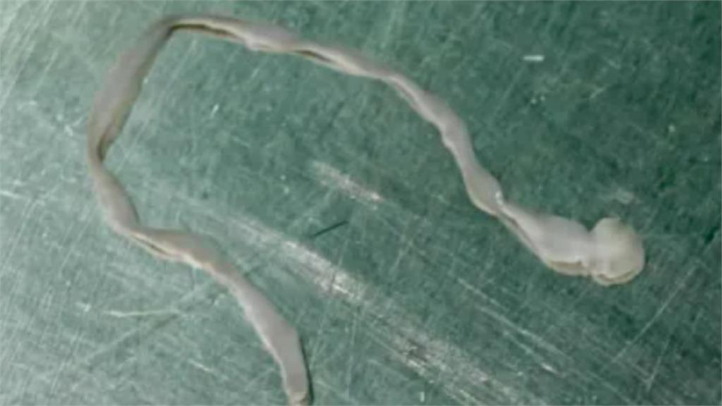 61歲女「腦中扯出8cm肥大活蟲」!他爆「牙痛曾做1事」網嚇瘋:怎會?