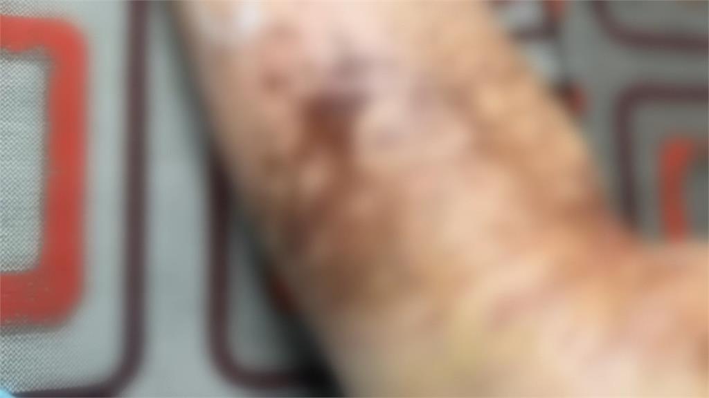 女學生腳剛上校車就關車門 左腳遭輾「賠償金談不攏」