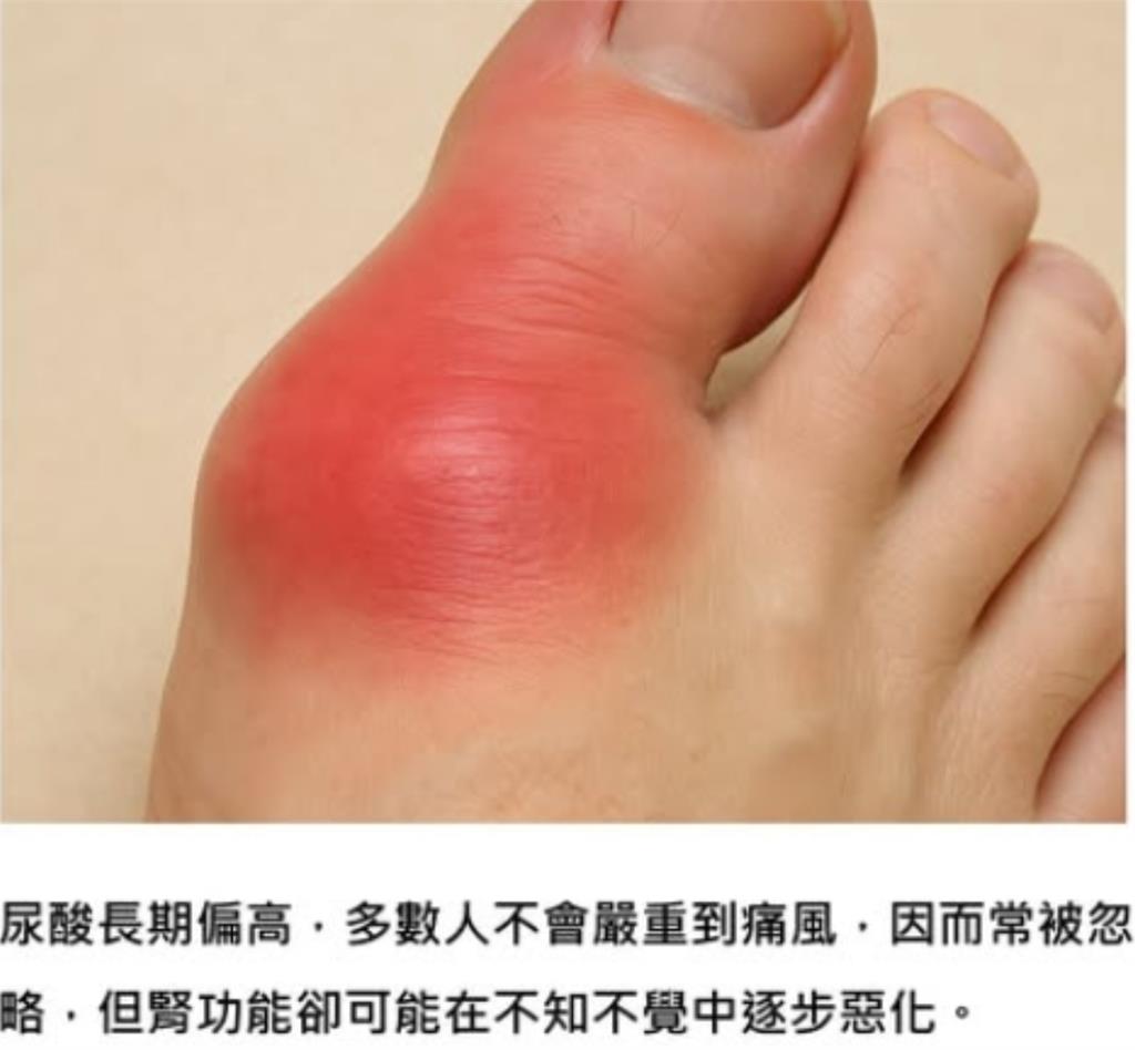 身體「4警訊」要注意…尿酸長期偏高、無症狀恐淪「1慢性病」風險因子!