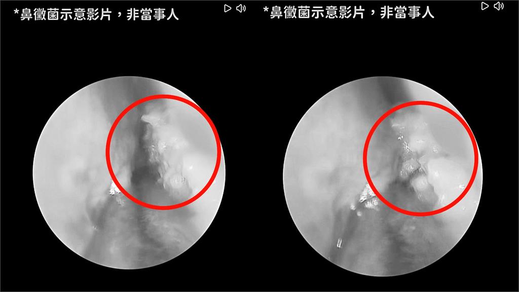 他口臭島老婆想離婚「刷牙也沒用」！醫一看元凶竟是「鼻子長滿黴菌球」畫面曝光
