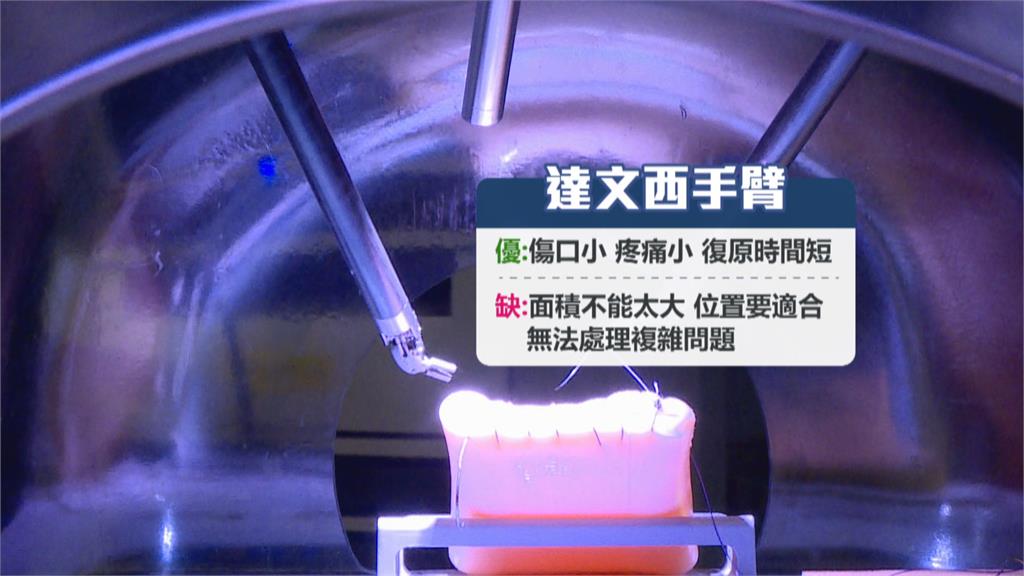 宜蘭第一人! 婦靠「達文西手術」救命