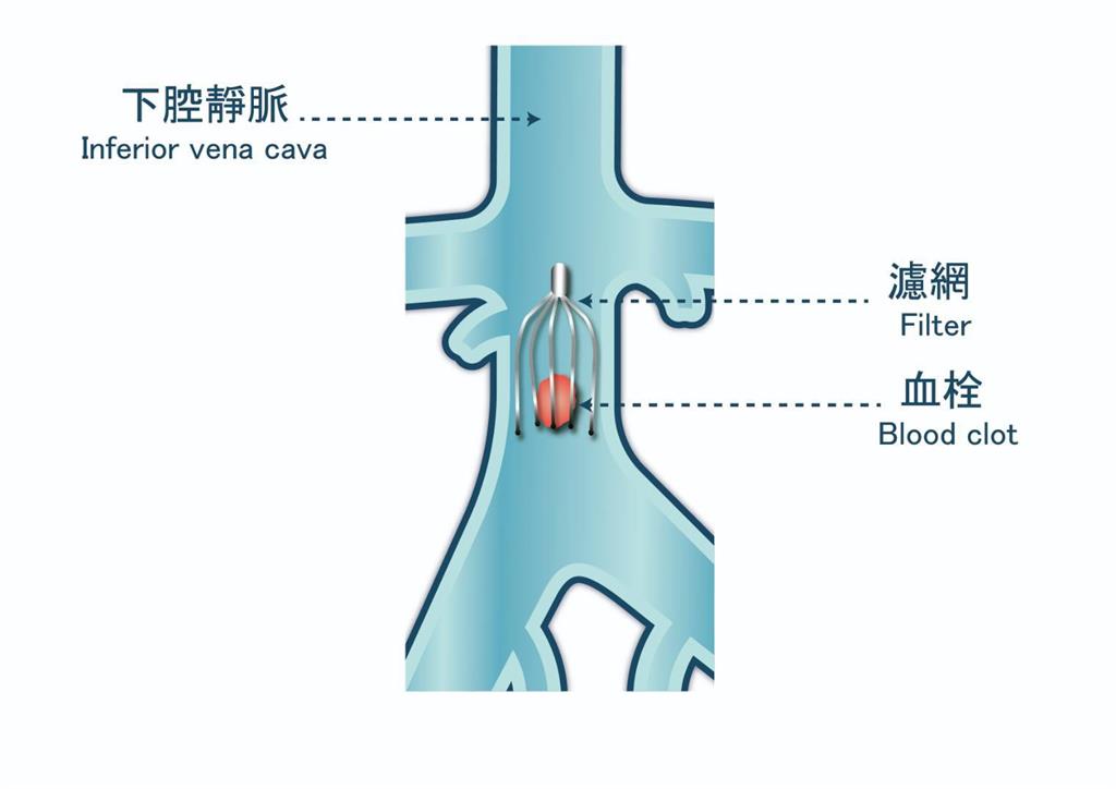 被忽視的靜脈殺手!醫談深層靜脈栓塞
