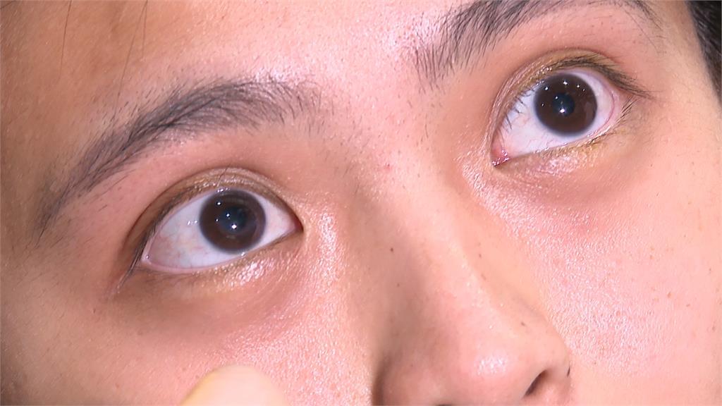 23歲女角膜變形視力剩0.25　全台首例手術免角膜移植