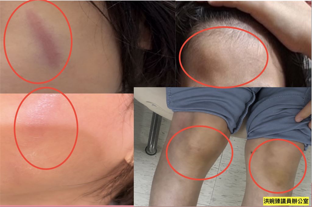快新聞／安置童滿臉傷！家長調監視器「竟表決才給看」 　洪婉臻怒轟市府傲慢