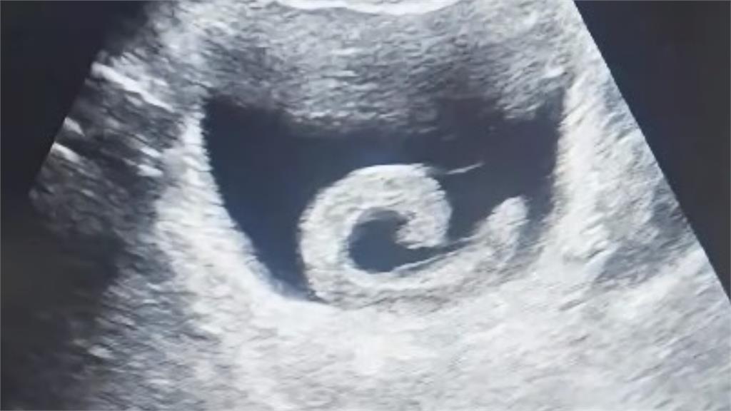 為追求「奇特效果」竟將活體生物塞尿道！他下秒「劇痛、尿不出來」急衝醫院