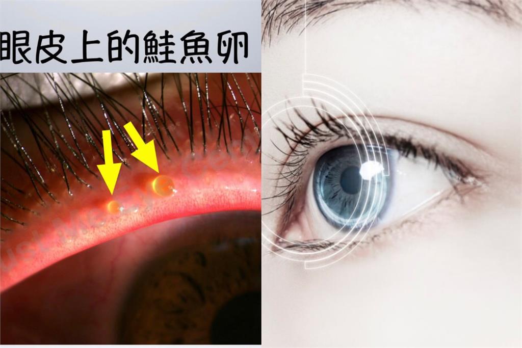 眼皮出現水泡像極「鮭魚卵」　醫師：眼瞼功能不良「後患」無窮