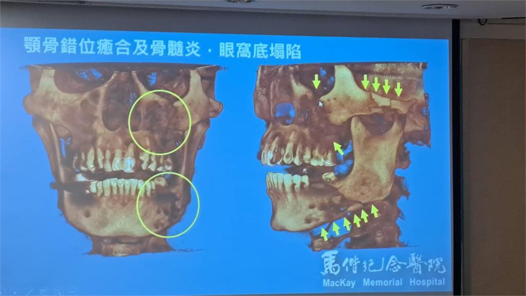 顏面骨手術複雜！　患者動刀三次談復原之路