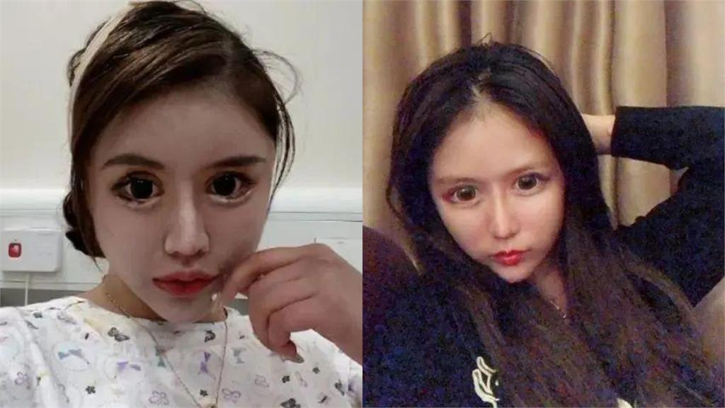 中國18歲網紅「5年整形百次」 「手術費破2千萬」網一看全嚇壞!