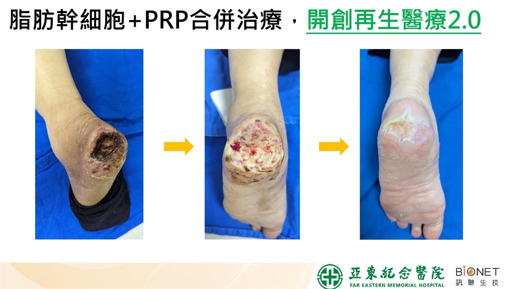 亞東醫院x訊聯細胞治療 助糖尿病足患者成功保足