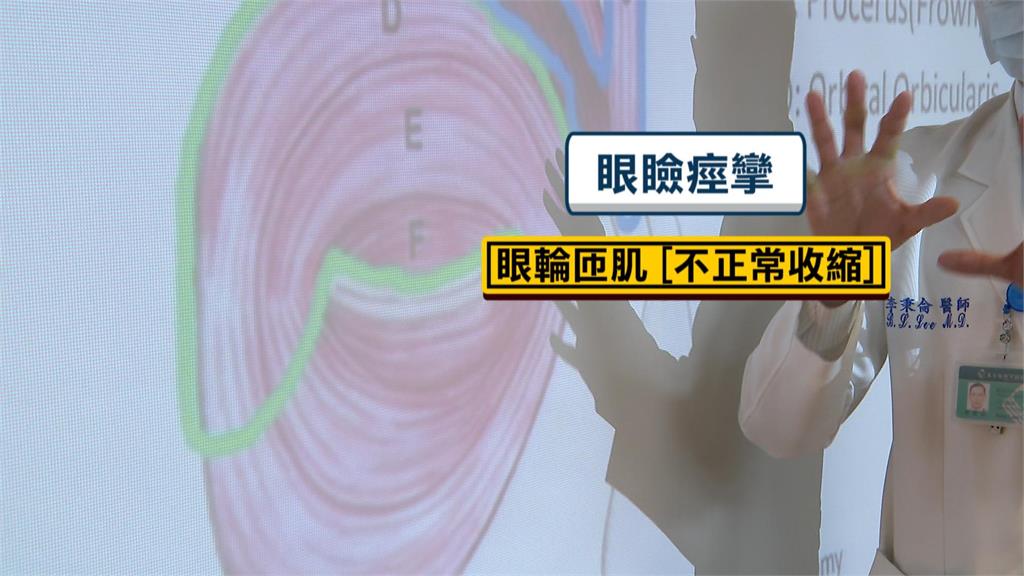 眼皮狂跳如「鬼壓眼」　「眼瞼痙攣」至今找嘸發病原因