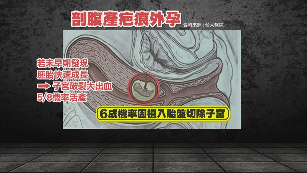 恐致子宮大出血! 台大團隊冒險協助「剖腹產疤痕外孕」順利生產
