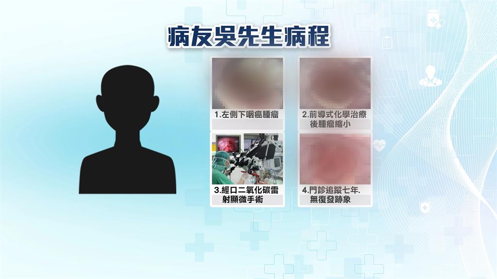 男罹咽喉癌只剩半年壽命 北榮「前導式化療組合」助續命