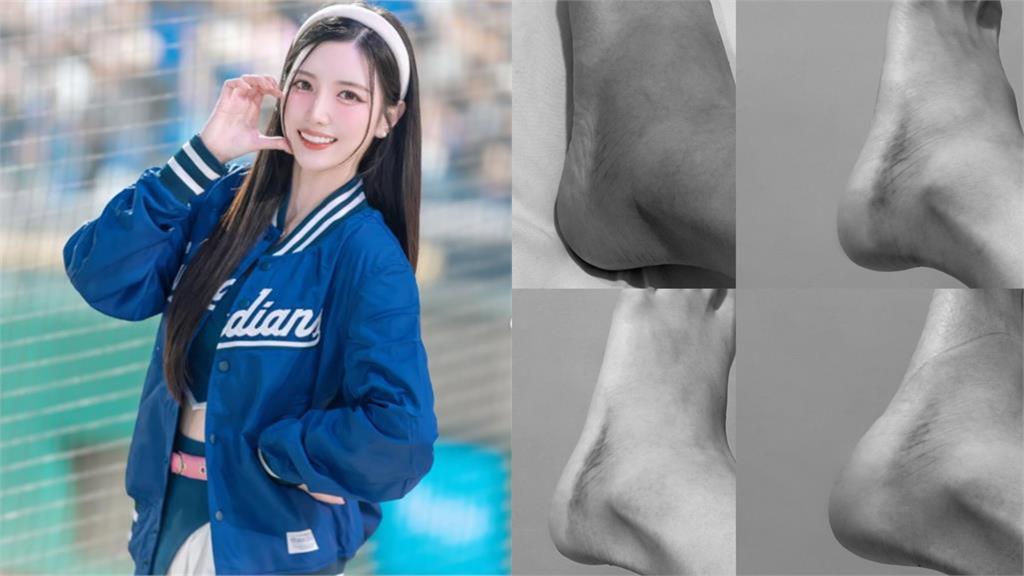 南珉貞熱舞慘摔「腳踝翻船」站不起!「腫到大片青紫」傷勢照流出嚇瘋網