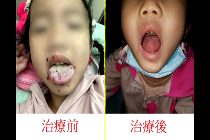 4歲女童滿嘴紅疹、水泡　不是腸病毒是「這個病」