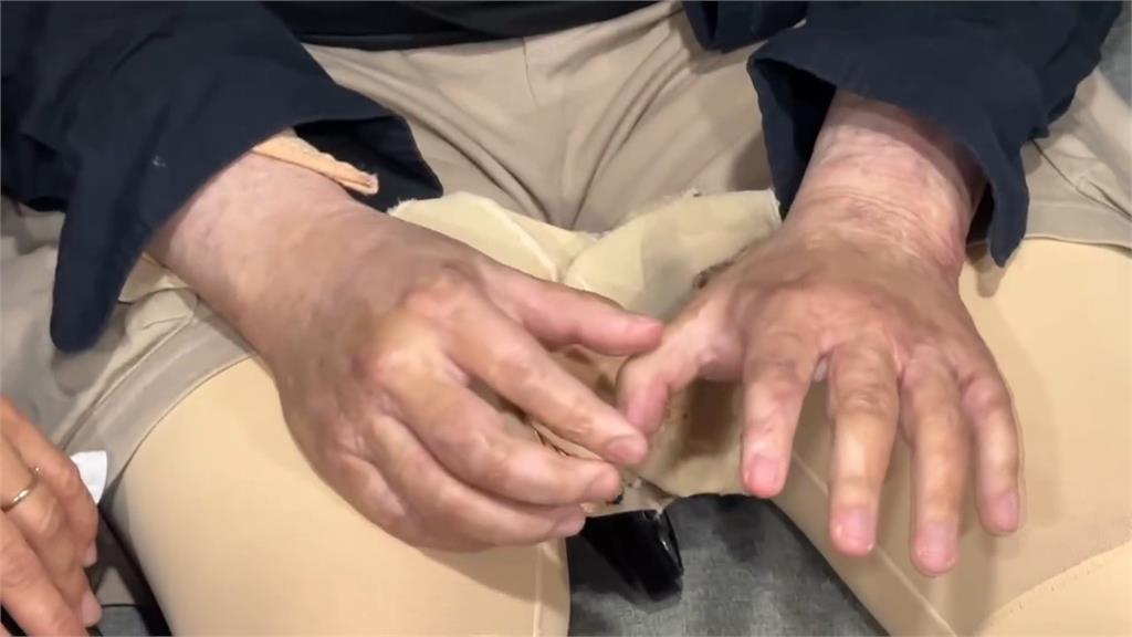 北捷南港機廠「感電事件」2年了！　受害員工淚訴遭刁難「走不出來」