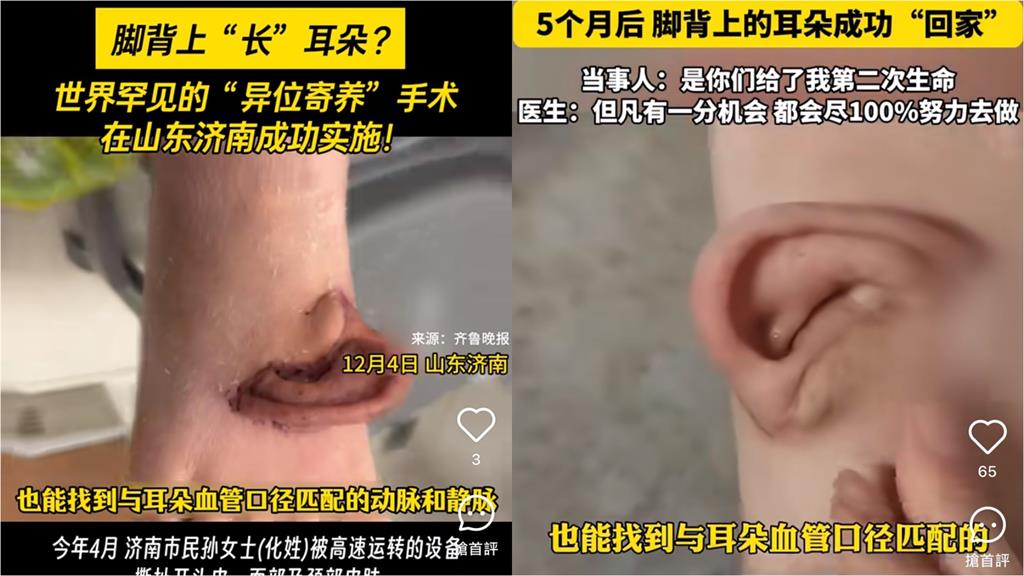 中國女工「左耳帶頭皮」被機器扯斷！耳朵奇蹟「寄生」腳背5個月後成功復位…