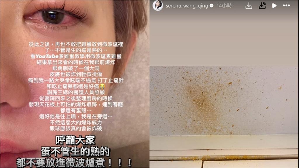 王晴微波蛋「慘炸左眼」最新近況曝 親媽1句認「不敢視訊」原因超鼻酸