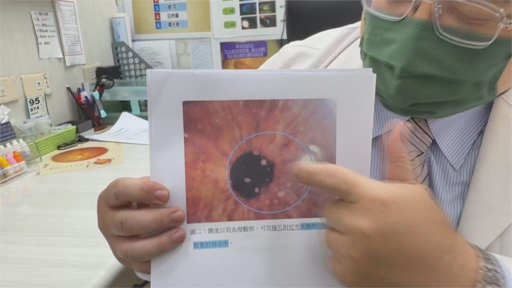女子長時間待高溫又熬夜　急性葡萄膜炎視力僅0.2
