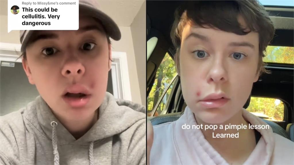 女網紅擠一顆痘痘竟「半臉癱瘓」！醫警告「這1處」最危險：死亡三角區