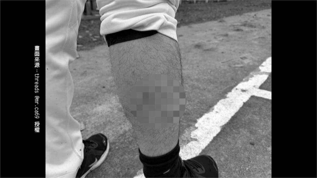 打棒球遭流浪狗追咬！左小腿現咬痕...　紡織界張孝全：老弱婦孺怎麼辦？