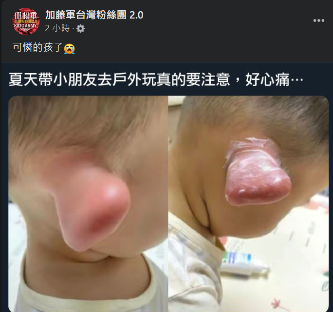 不是P圖！童遭蚊蟲咬「耳朵腫成史瑞克」　過來人父母：第一次被咬就會這樣