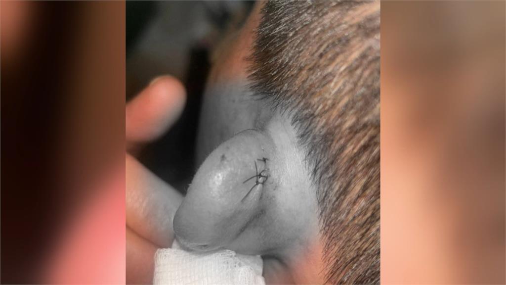 排慈護宮發財金爆衝突！　女遭廟方人員甩棍毆打「耳縫3針」