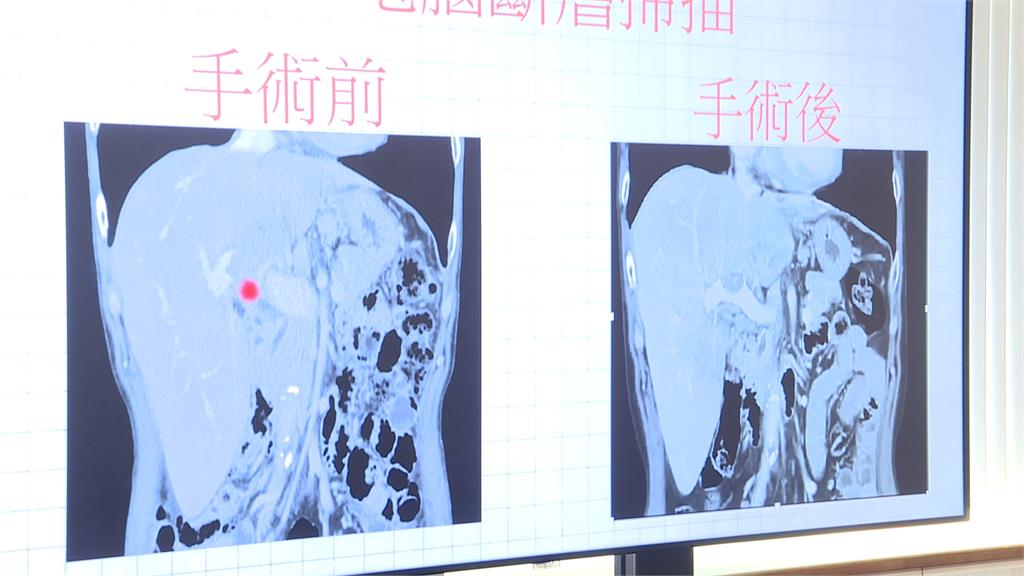 被宣告嘸效　台中肝癌末期病患　科別合併治療成功逆轉
