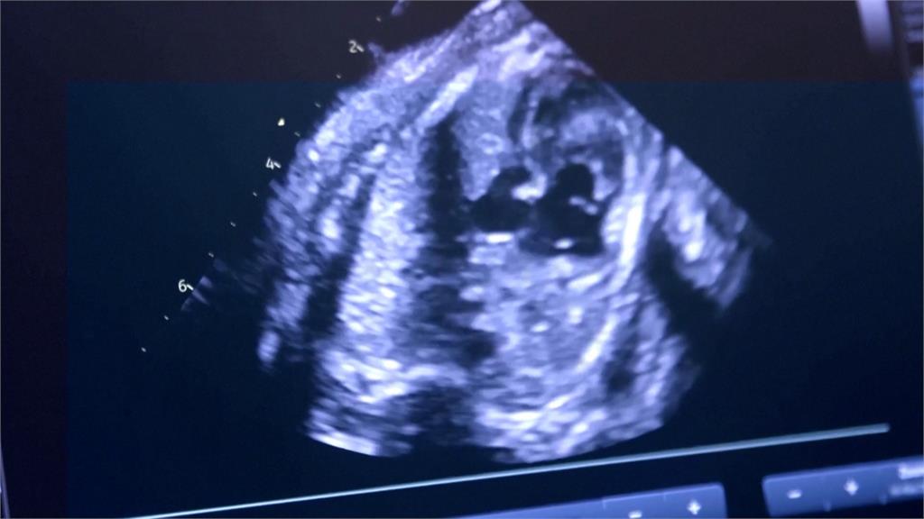 人造子宮拯救「極度早產兒」　成功讓動物胚胎存活12天