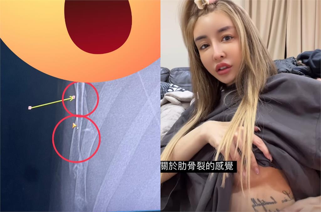 超兇教主爆意外「肋骨插內臟」狂尖叫！崩潰喊「比整型還痛」：已寫好遺囑