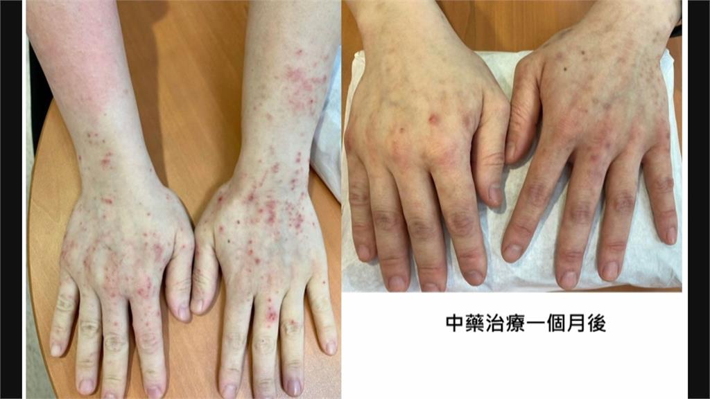 盛夏別亂補！　女「溼性體質」喝藥燉排骨溼疹纏身