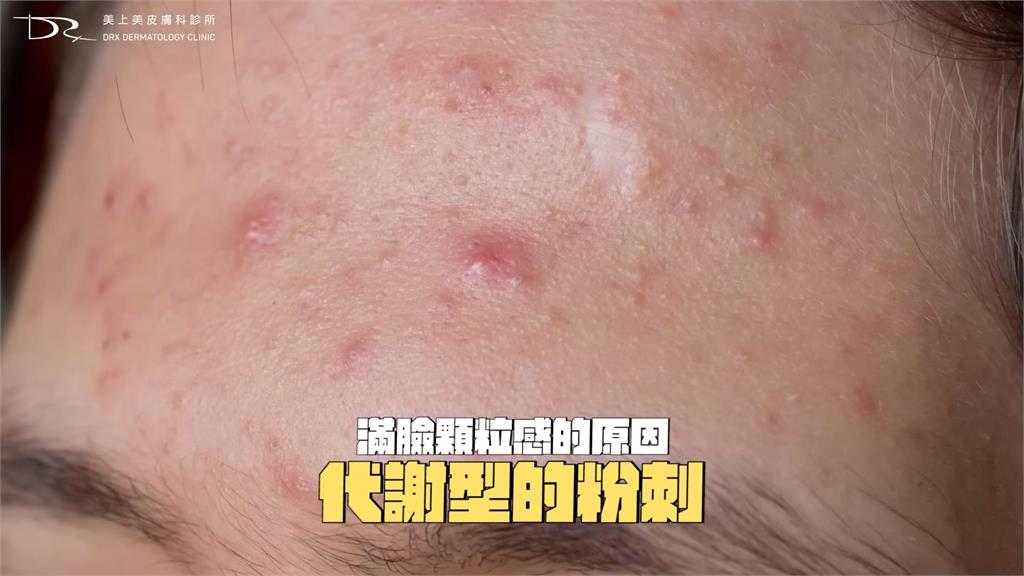 臉部顆粒感很重？醫指3主因釀粗糙感　指「用錯保養品」：角質代謝會異常