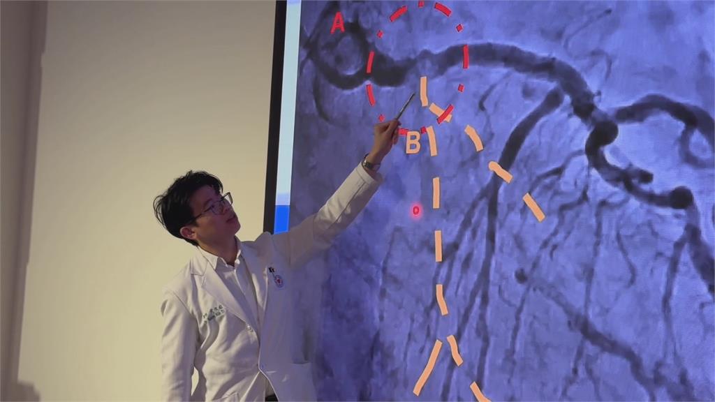 72歲女子心臟血管「長石頭」　胸痛、冒冷汗一週險奪命