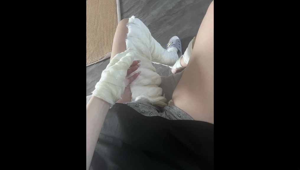 孩童玩氫氣氣球釀爆炸!媽媽火燒身急逃求生 竟遭網路霸凌加劇傷口