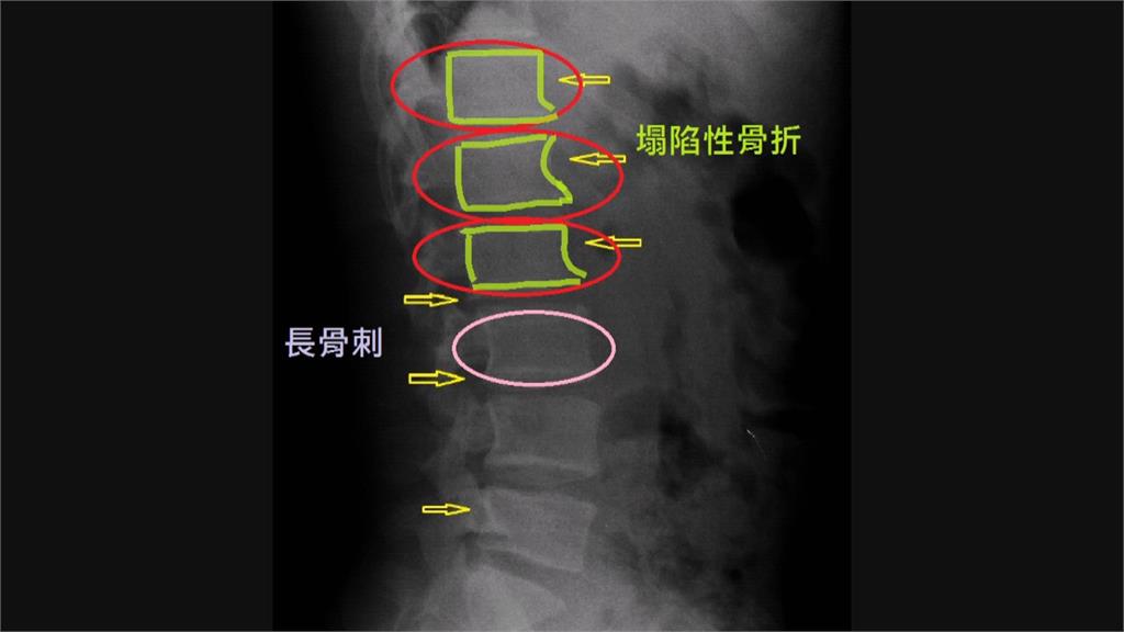 舉重變「歪腰」！　14歲選手腰椎塌陷還長骨刺