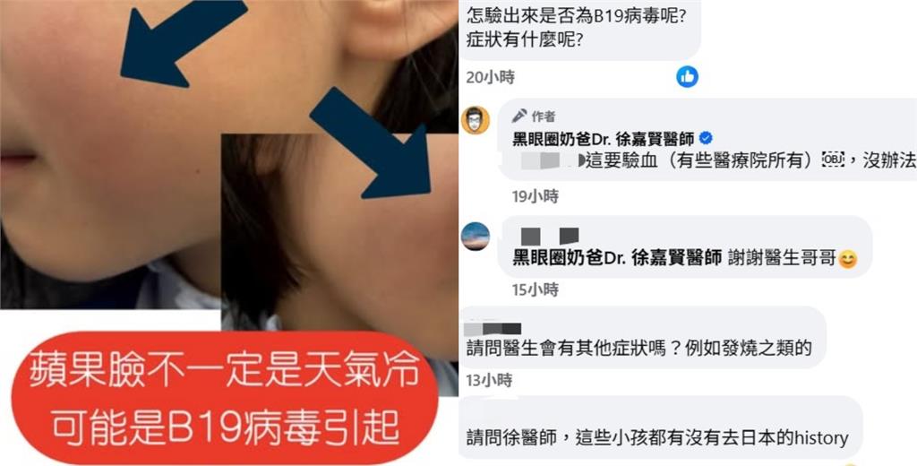 冬天臉頰泛紅「像被打巴掌」竟不是過敏！醫籲「蘋果病」症狀：易被忽略