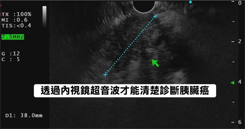 半年瘦10公斤「女腹痛就醫」胃沒問題!醫見2症狀「一照胰臟」已是三期癌