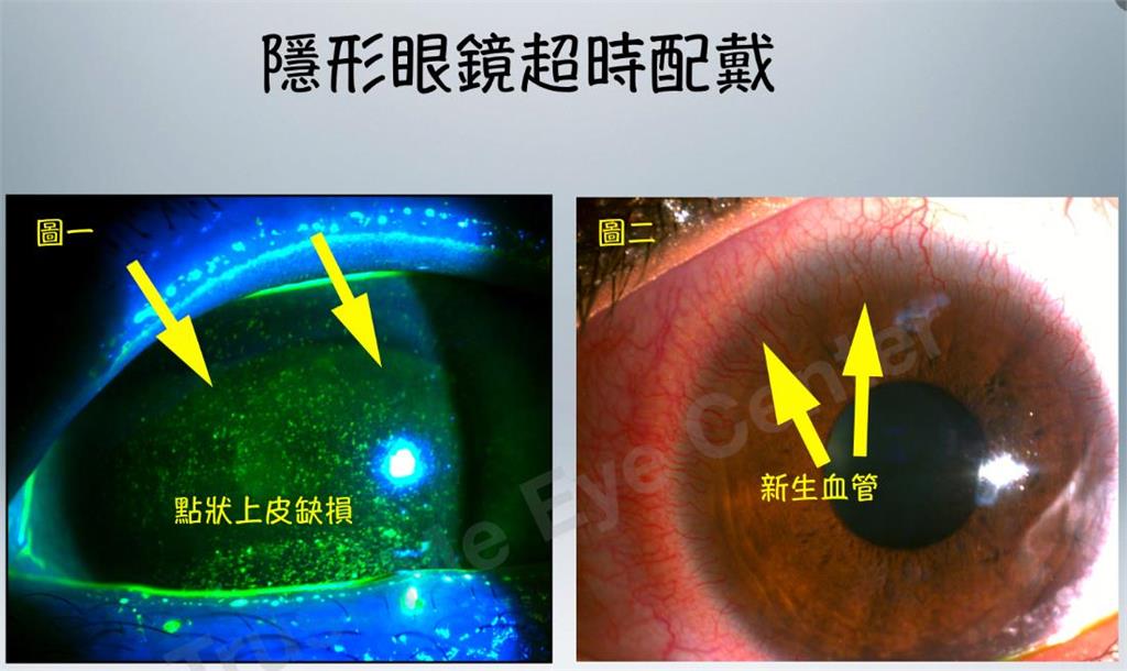 寒冬別忽視眼睛乾澀問題!醫:隱形眼鏡戴太久 小心角膜缺氧惹麻煩