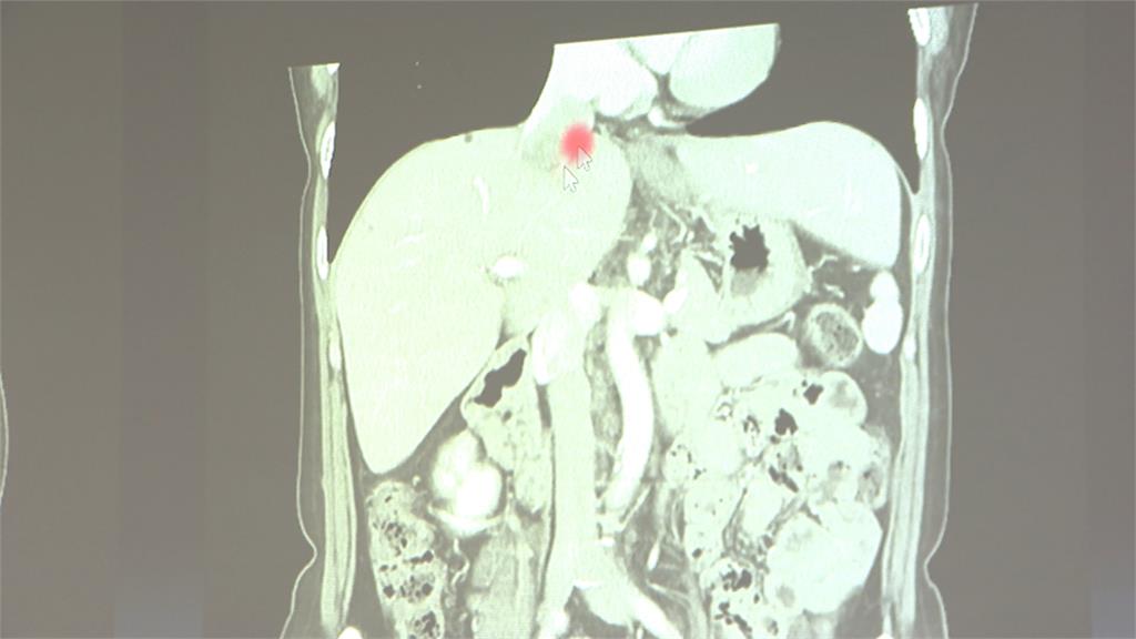 醫療奇蹟！　肝腫瘤長進心臟　北榮團隊「拆彈」救回一命